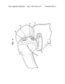 Method of preparing a femur for implantation of a femoral implant diagram and image