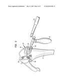 Method of preparing a femur for implantation of a femoral implant diagram and image