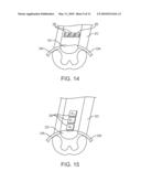 SYSTEM AND METHOD FOR INCREASING RELATIVE INTENSITY BETWEEN CATHODES AND ANODES OF NEUROSTIMULATION SYSTEM USING PULSE SLICING diagram and image