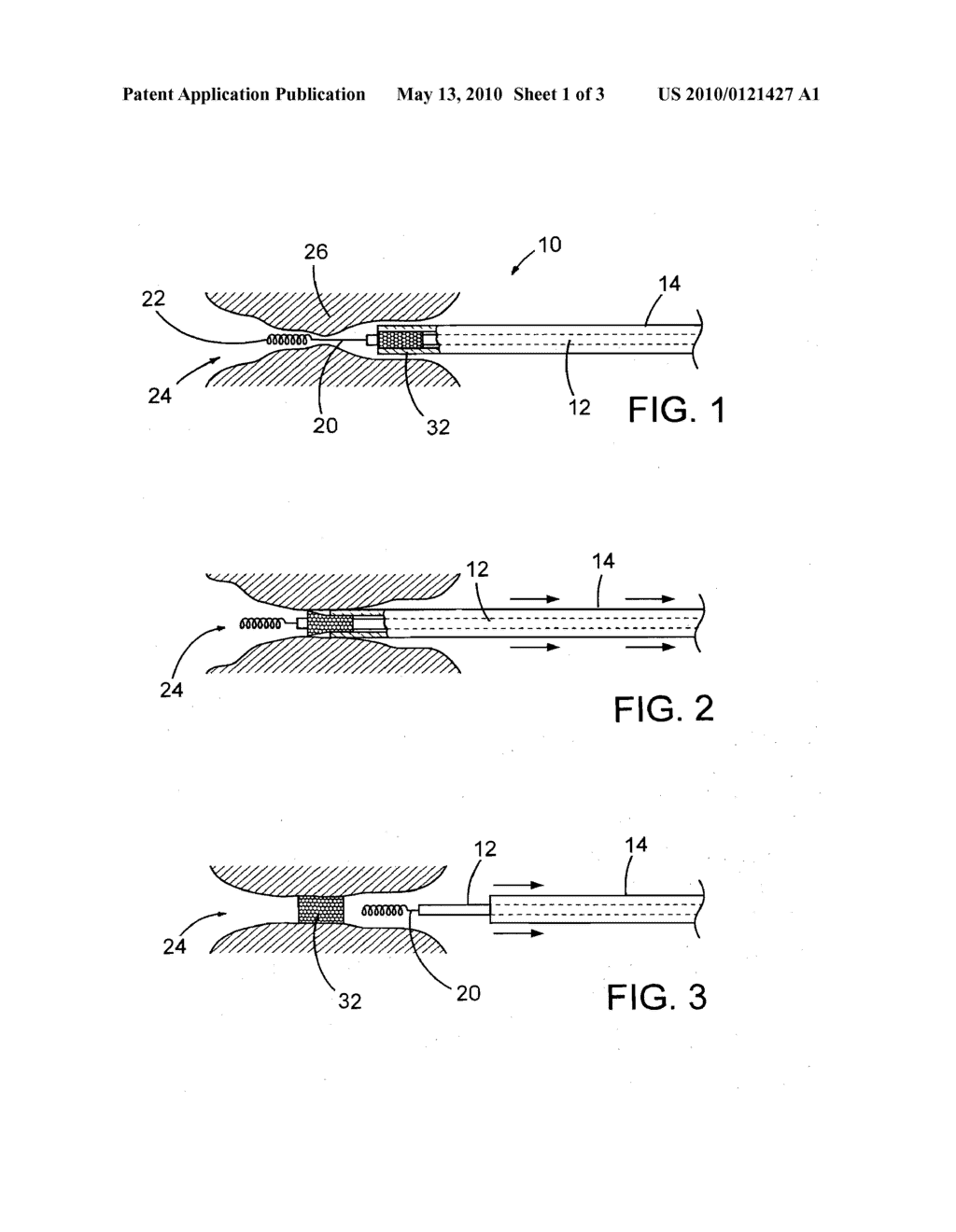 ENDOPROSTHESIS DELIVERY SYSTEM - diagram, schematic, and image 02