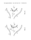 Stent Graft Having a Flexible, Articulable, and Axially Compressible Branch Graft diagram and image