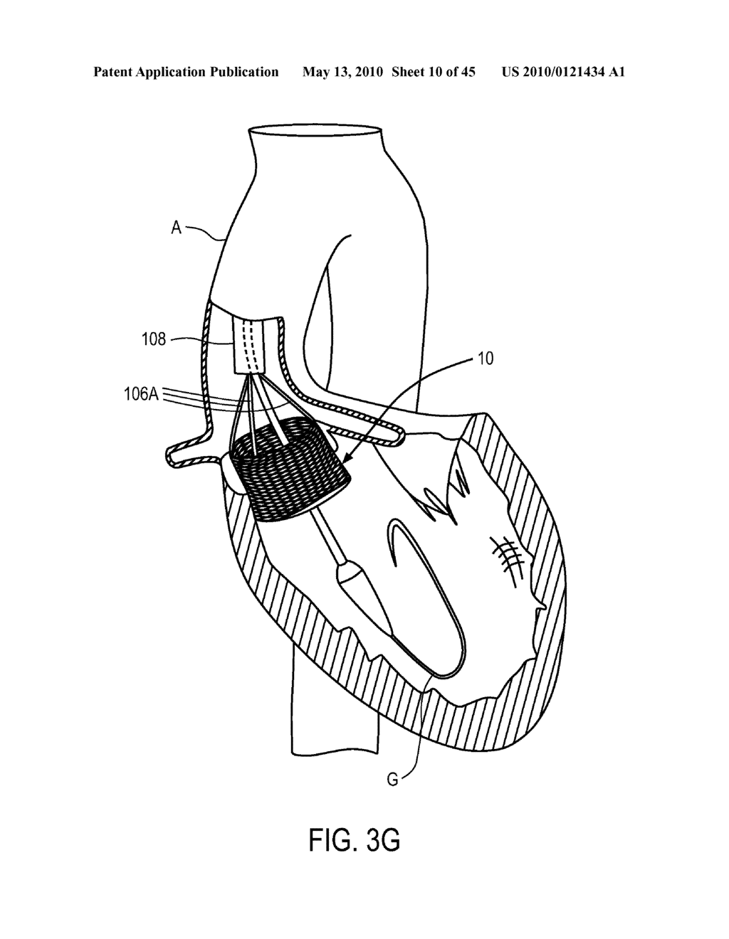 Medical Devices and Delivery Systems for Delivering Medical Devices - diagram, schematic, and image 11