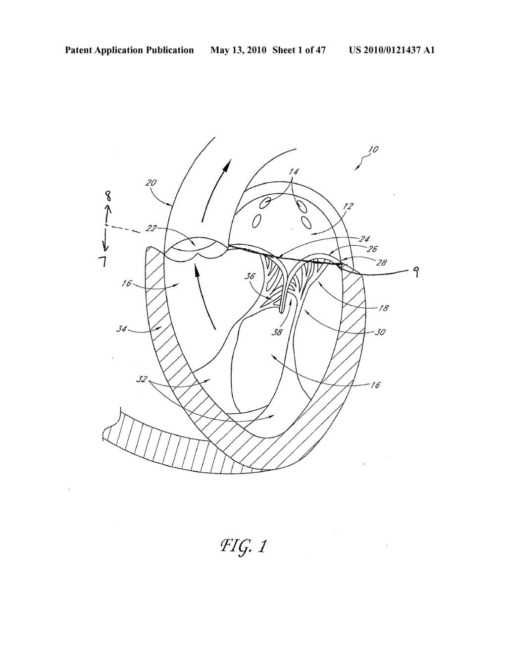 TRANSVALVULAR INTRAANNULAR BAND AND CHORDAE CUTTING FOR ISCHEMIC AND DILATED CARDIOMYOPATHY - diagram, schematic, and image 02