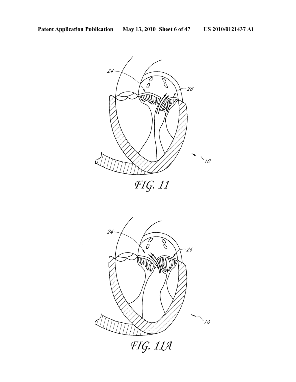 TRANSVALVULAR INTRAANNULAR BAND AND CHORDAE CUTTING FOR ISCHEMIC AND DILATED CARDIOMYOPATHY - diagram, schematic, and image 07