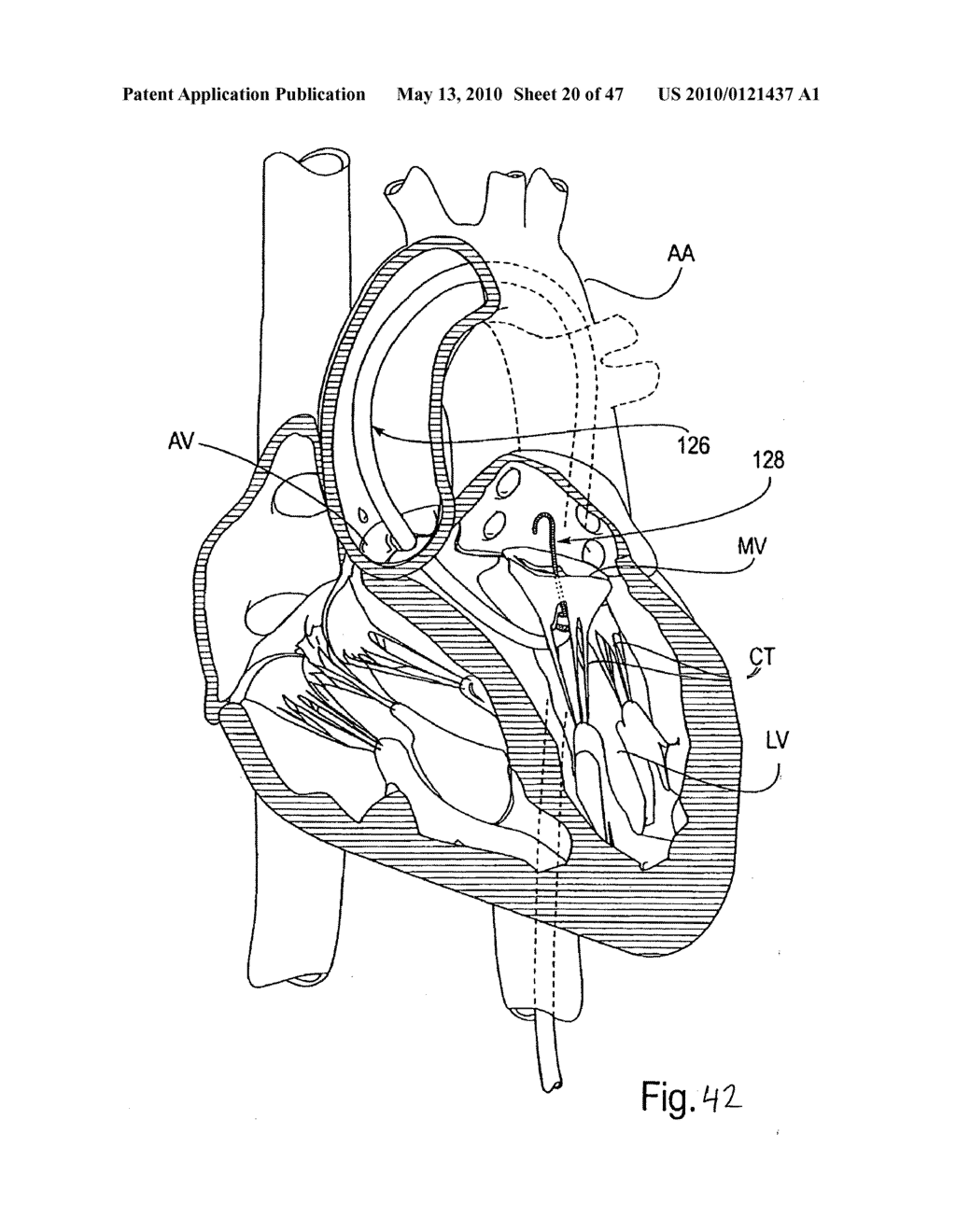 TRANSVALVULAR INTRAANNULAR BAND AND CHORDAE CUTTING FOR ISCHEMIC AND DILATED CARDIOMYOPATHY - diagram, schematic, and image 21