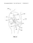 METHOD FOR REPLACING A LIGAMENT IN A KNEE diagram and image