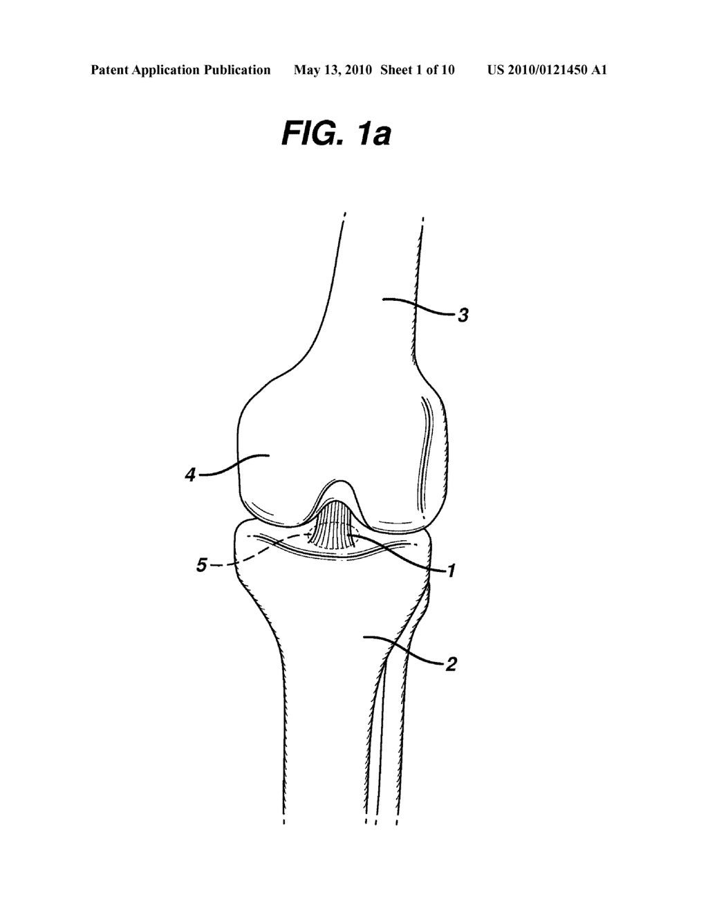 METHOD FOR ANCHORING AUTOLOGOUS OR ARTIFICIAL TENDON GRAFTS IN BONE - diagram, schematic, and image 02