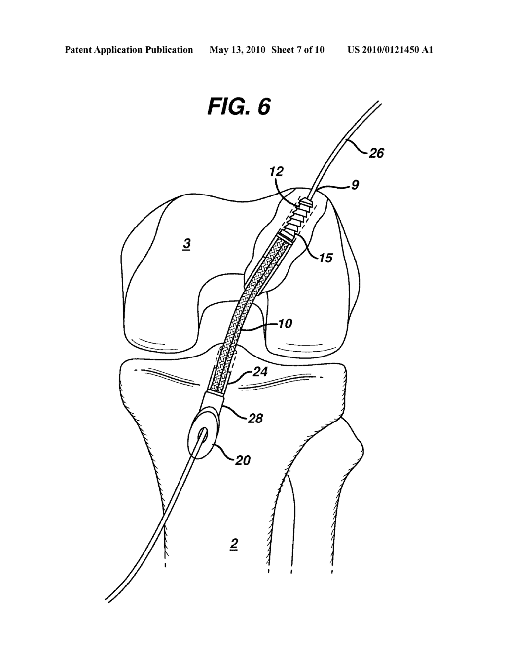 METHOD FOR ANCHORING AUTOLOGOUS OR ARTIFICIAL TENDON GRAFTS IN BONE - diagram, schematic, and image 08