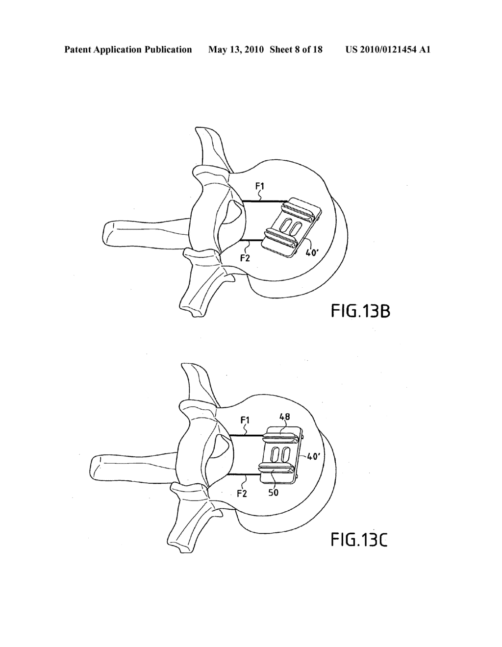 METHOD OF IMPLANTING INTERVERTEBRAL DISK PROSTHESIS - diagram, schematic, and image 09