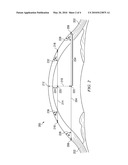 METHOD OF FITTING RIGID GAS-PERMEABLE CONTACT LENSES FROM HIGH RESOLUTION IMAGING diagram and image