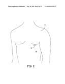 SUBCUTANEOUS LEAD GUIDANCE diagram and image