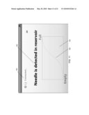 PRESSURE BASED REFILL STATUS MONITOR FOR IMPLANTABLE PUMPS diagram and image