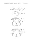 DISPOSABLE ABSORBENT ARTICLE HAVING DUAL LAYER BARRIER CUFF STRIPS diagram and image