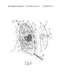 System for treating undesired body tissue diagram and image