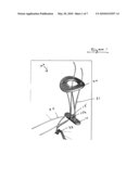 AC JOINT REPAIR USING SUTURE BUTTON GRAFT CONSTRUCT AND METHOD OF SURGERY diagram and image