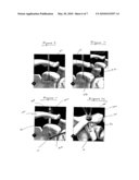 AC JOINT REPAIR USING SUTURE BUTTON GRAFT CONSTRUCT AND METHOD OF SURGERY diagram and image