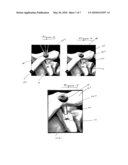 AC JOINT REPAIR USING SUTURE BUTTON GRAFT CONSTRUCT AND METHOD OF SURGERY diagram and image