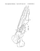 FIXATION PLATE FOR USE IN THE LAPIDUS APPROACH diagram and image