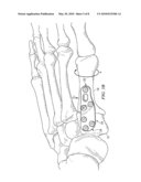 FIXATION PLATE FOR USE IN THE LAPIDUS APPROACH diagram and image