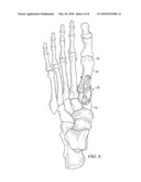 FIXATION PLATE FOR USE IN THE LAPIDUS APPROACH diagram and image