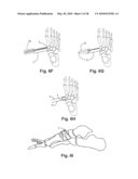 SURGICAL DEVICE, SYSTEM AND METHOD OF USE THEREOF diagram and image