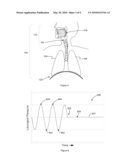 Method and Device For the Detection, Identification and Treatment of Sleep Apnea/Hypopnea diagram and image