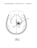 SATELLITE THERAPY DELIVERY SYSTEM FOR BRAIN NEUROMODULATION diagram and image