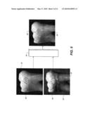 METHOD FOR DETECTION OF CARIES diagram and image