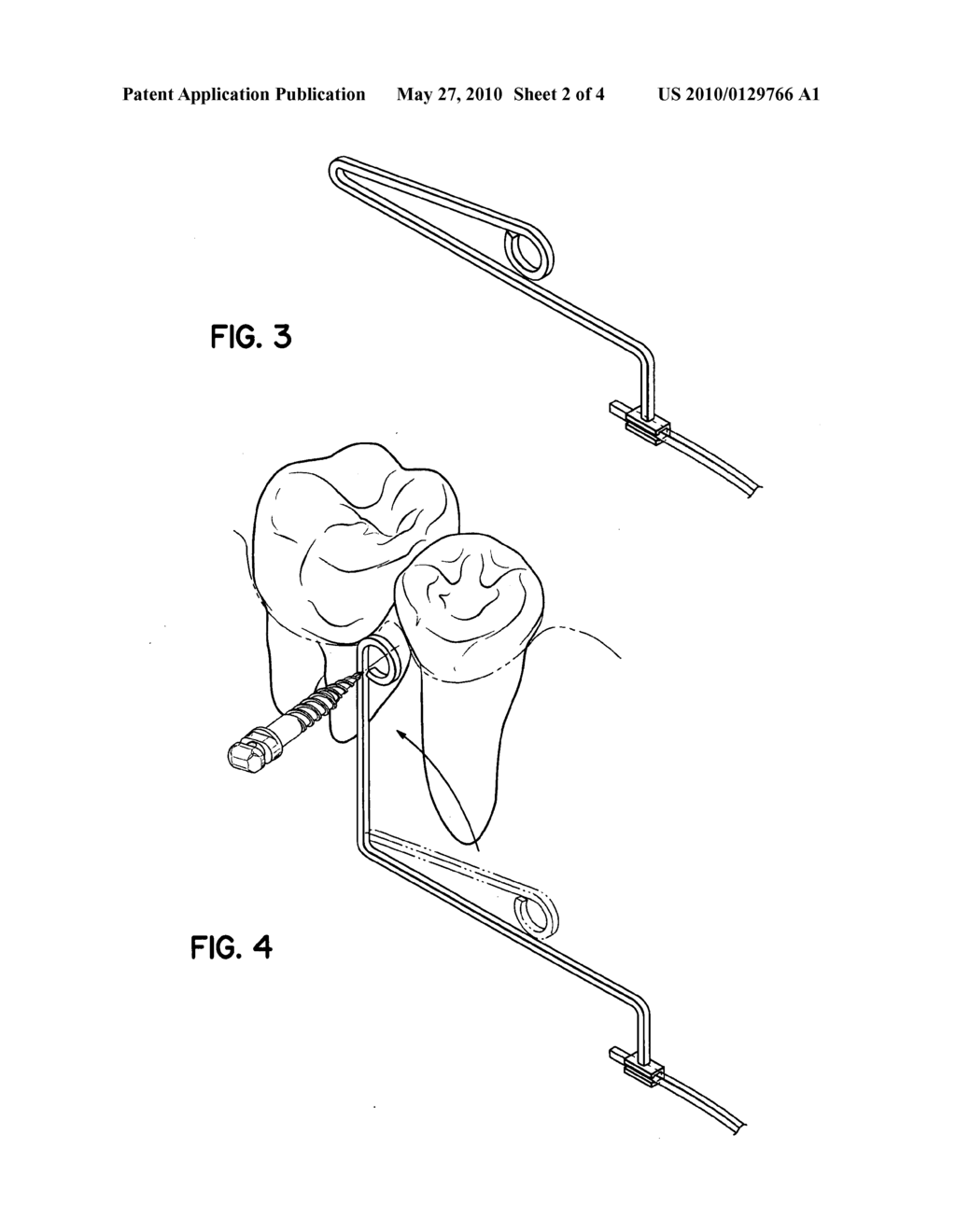 ORTHODONTIC RETRACTION ARCH AND SPRING - diagram, schematic, and image 03