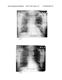 Use of Doxycycline in the Treatment of Idiopathic Pulmonary Fibrosis diagram and image