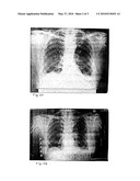 Use of Doxycycline in the Treatment of Idiopathic Pulmonary Fibrosis diagram and image