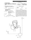 Implantable device for the intermittent occlusion of blood vessel diagram and image