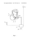 Implantable device for the intermittent occlusion of blood vessel diagram and image