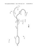 Cryogenic Ablation System and Method diagram and image