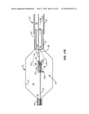 Cryogenic Ablation System and Method diagram and image