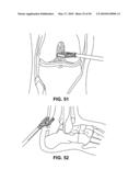 METHODS OF SUTURING AND REPAIRING TISSUE USING A CONTINUOUS SUTURE PASSER DEVICE diagram and image