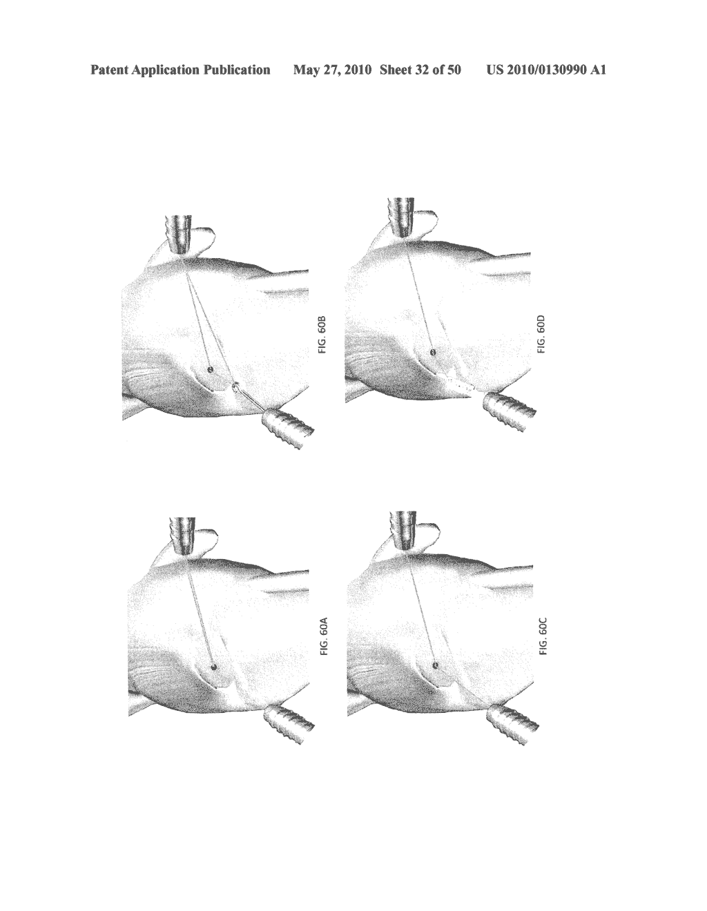 METHODS OF SUTURING AND REPAIRING TISSUE USING A CONTINUOUS SUTURE PASSER DEVICE - diagram, schematic, and image 33