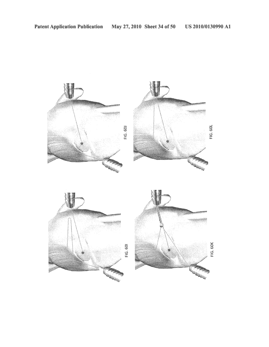 METHODS OF SUTURING AND REPAIRING TISSUE USING A CONTINUOUS SUTURE PASSER DEVICE - diagram, schematic, and image 35