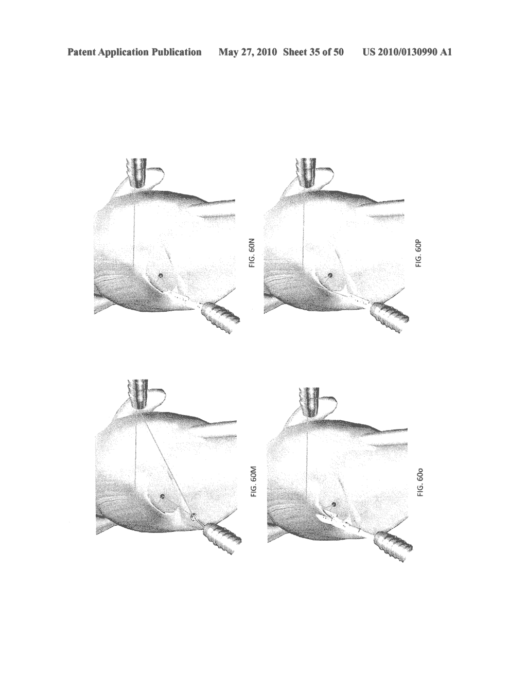 METHODS OF SUTURING AND REPAIRING TISSUE USING A CONTINUOUS SUTURE PASSER DEVICE - diagram, schematic, and image 36
