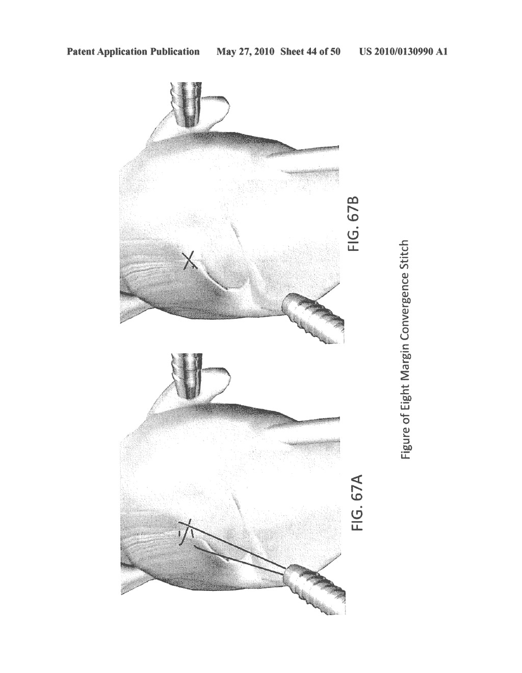 METHODS OF SUTURING AND REPAIRING TISSUE USING A CONTINUOUS SUTURE PASSER DEVICE - diagram, schematic, and image 45