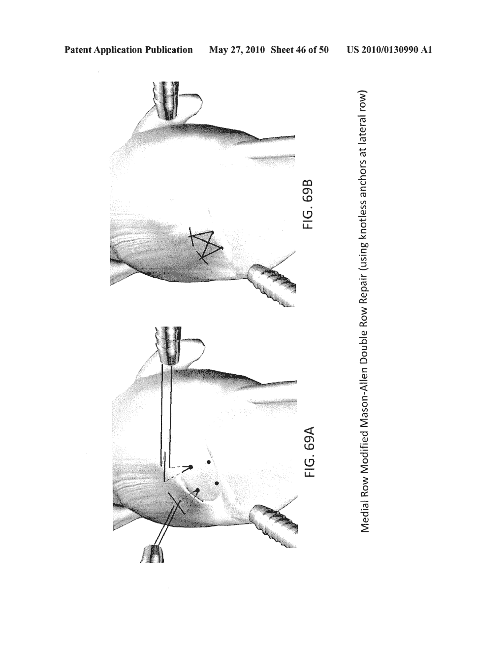 METHODS OF SUTURING AND REPAIRING TISSUE USING A CONTINUOUS SUTURE PASSER DEVICE - diagram, schematic, and image 47