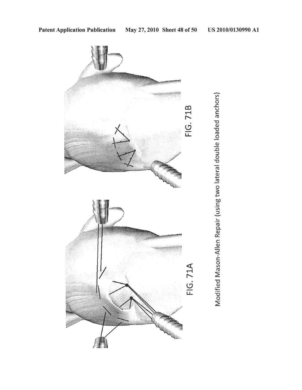 METHODS OF SUTURING AND REPAIRING TISSUE USING A CONTINUOUS SUTURE PASSER DEVICE - diagram, schematic, and image 49