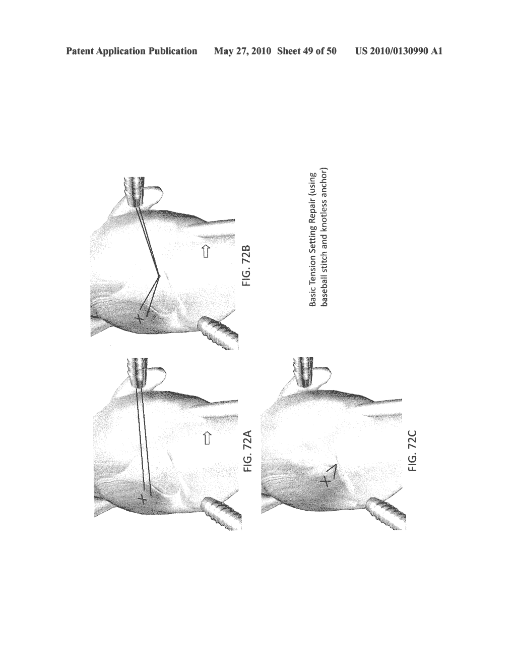 METHODS OF SUTURING AND REPAIRING TISSUE USING A CONTINUOUS SUTURE PASSER DEVICE - diagram, schematic, and image 50