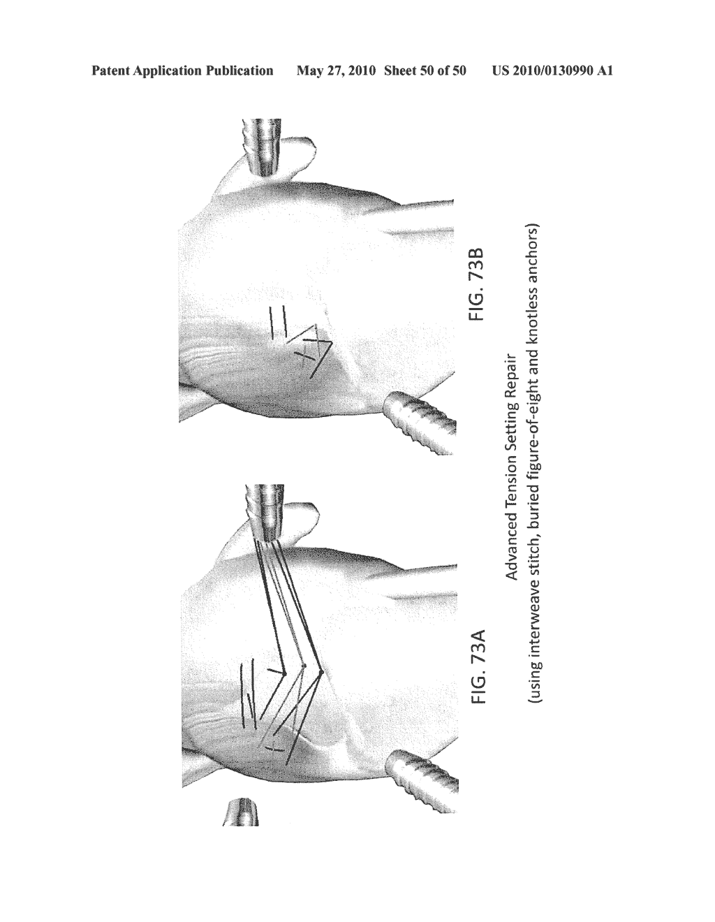 METHODS OF SUTURING AND REPAIRING TISSUE USING A CONTINUOUS SUTURE PASSER DEVICE - diagram, schematic, and image 51