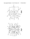 VISCO-ELASTIC FACET JOINT IMPLANT diagram and image