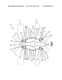 VISCO-ELASTIC FACET JOINT IMPLANT diagram and image