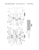 VISCO-ELASTIC FACET JOINT IMPLANT diagram and image