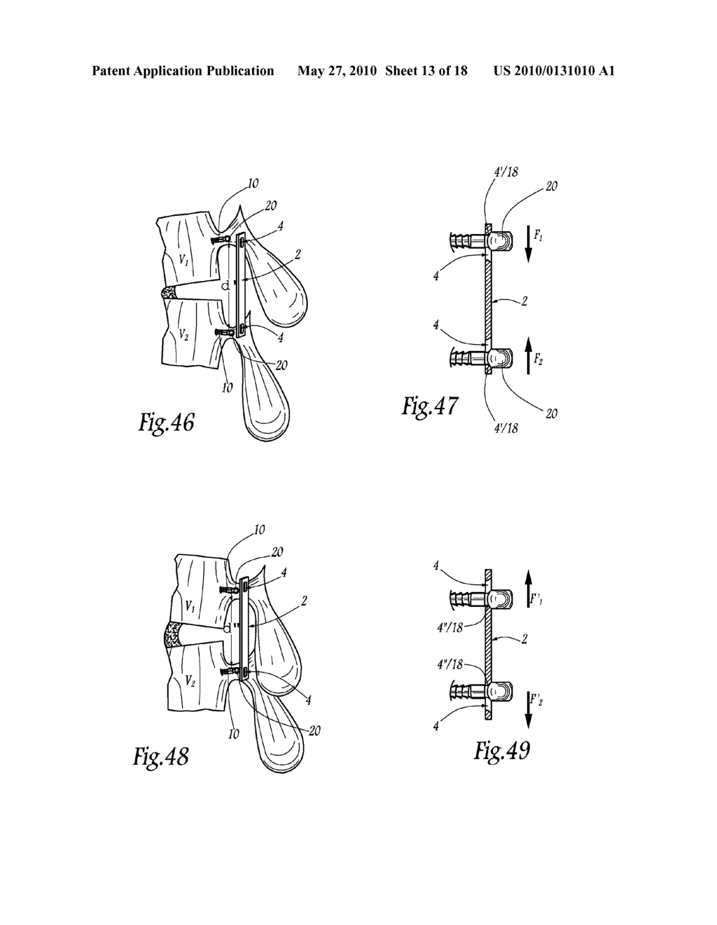 EXTRA DISCAL INTERVERTEBRAL STABILIZATION ELEMENT FOR ARTHRODESIS - diagram, schematic, and image 14