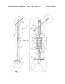 ELECTROTHERAPY ORTHOPEDIC DEVICE diagram and image