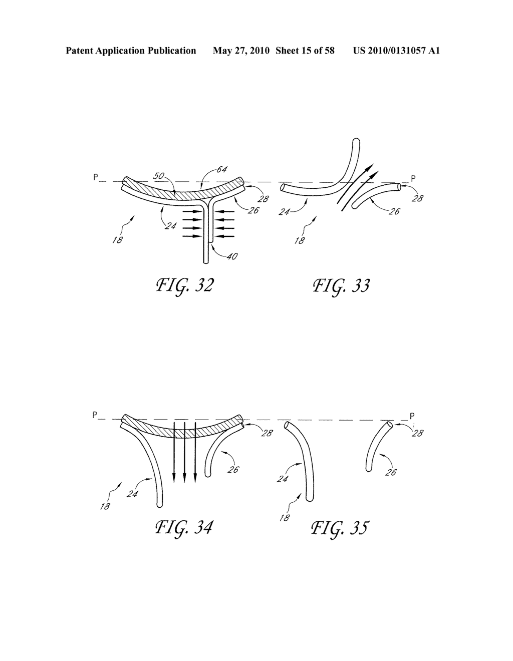 TRANSVALVULAR INTRAANNULAR BAND FOR AORTIC VALVE REPAIR - diagram, schematic, and image 16